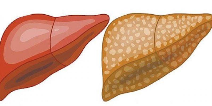 ارتفاع حالات الكبد الدهني في الأطفال، أستاذة بالقومي للبحوث تحذر - أخبار كلمتك